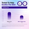 image:imageAnua UltraThin Spot Cover Patch Invisible Hydrocolloid Acne Patch for Face Cute Pimple Patches Centella Care for Sensitive Skin KPop Demon Hunters Case Korean Skincare 55ea