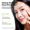 image:imageANUA Azelaic Acid CICA Skin Soothing Moisturizer Lightweight amp Redness Relief For Acne Prone Skin Fragrance Free Korean Skincare 338 fl oz